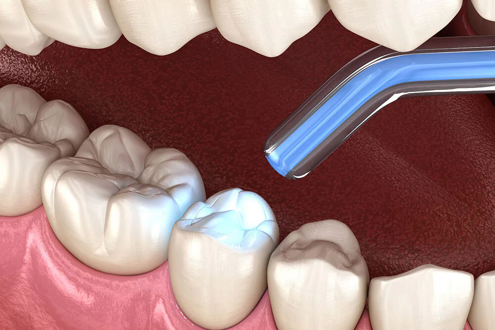 Illustration of a dental filling being light-cured in a back tooth