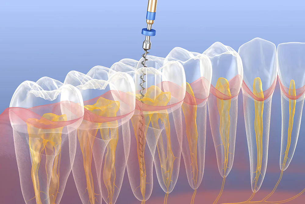 Illustration of root canal treatment: a file cleaning the inner canal of a tooth